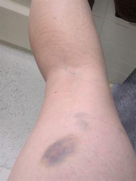 My wife noticed unexplained bruises on her inner thigh near the hip joint day before yesterday. . My girlfriend has bruises on her inner thighs